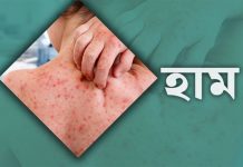২৪ ঘণ্টায় হামের উপসর্গে আরও ৩ জনের মৃত্যু