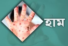 হাম উপসর্গে আরও ৮ শিশুর মৃত্যু