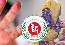 হাম উপসর্গে ৭ শিশুর মৃত্যু