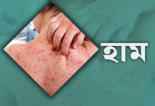 একদিনে হাম উপসর্গে ৮ জনের মৃত্যু, নতুন রোগী ১০৬৫