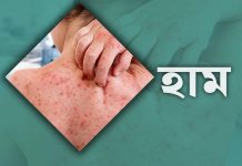 ২৪ ঘণ্টায় হাম উপসর্গে ৭ জনের মৃত্যু